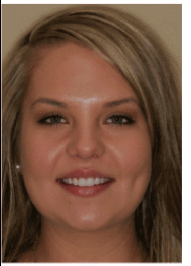 Dental Veneers - Before treatment at Kentish Smiles